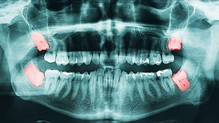 image of wisdom teeth in doreen vic