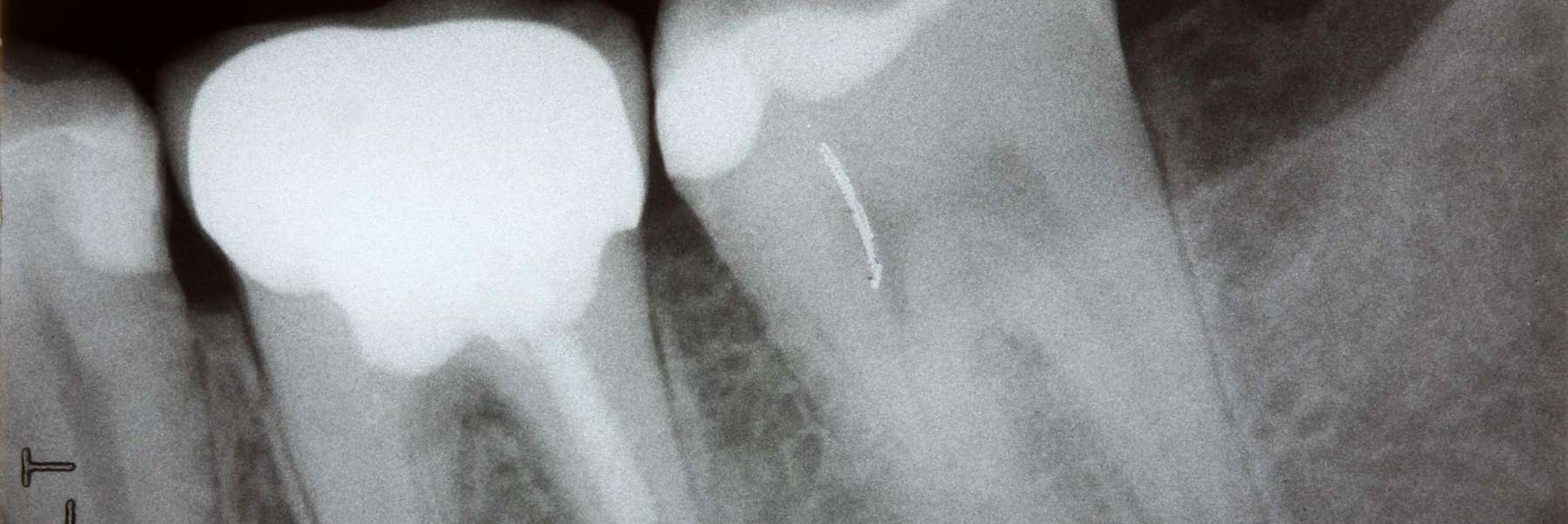 wisdom teeth removal in doreen vic